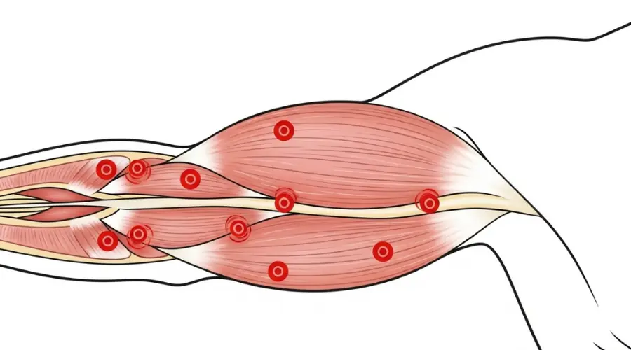 Arm trigger point dry needling diagram