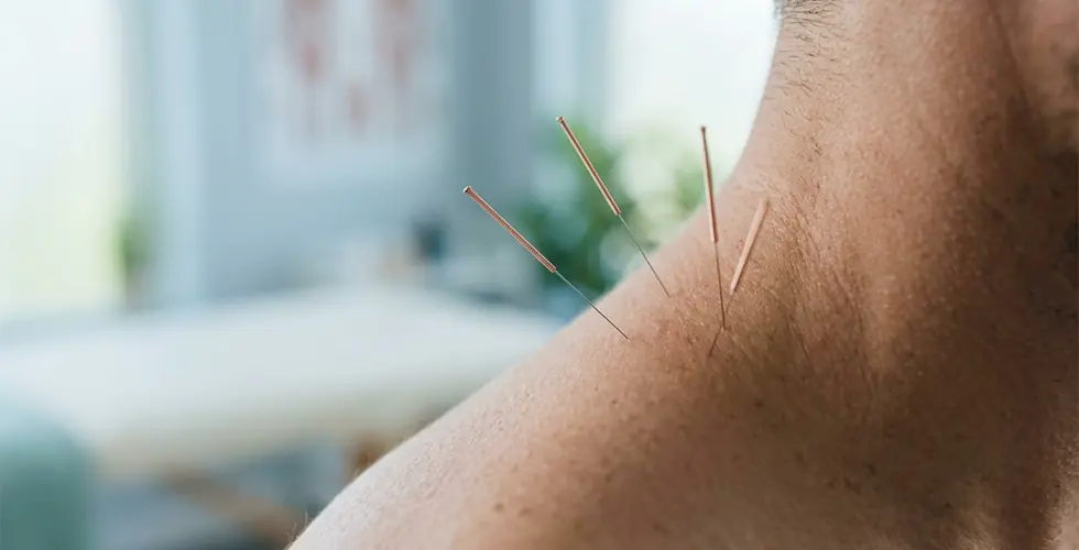 Close up view of thin solid monofilament needles inserted into a patient's neck and shoulder during a dry needling session.